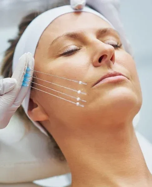 نخ لیفتینگ صورت