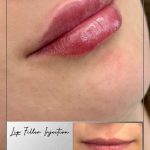 فیلر لب
